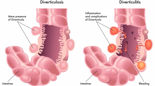 Diverticulosis & Diverticulitis – What is the difference and why should I care?